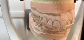 tratamento-de-DTM-01